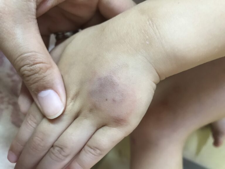 採血後のあざの原因